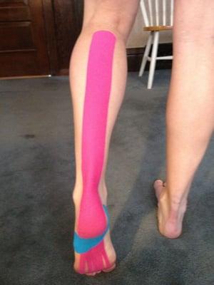 Kinesiotaping for plantar fasciitis.