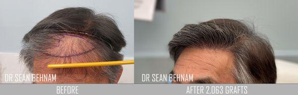 FUE hair transplant:  Repair of a poorly performed hair transplant.   Notice the naturalness and density. Work performed by Dr Sean Behnam