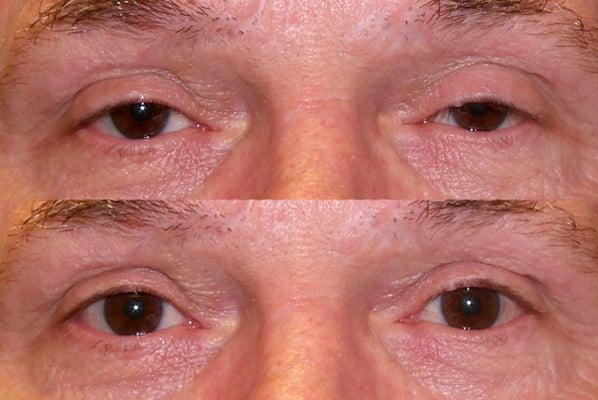 Before and After Upper eyelid ptosis (droopy eyelid surgery)
 www.DrMarkBrown.com 
 Mobile, AL 36609
 251-650-5437