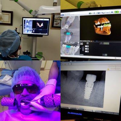 DrThaw has new high tech equipment! A X-Guide Dynamic 3D Navigation system to control the exact POSITION, ANGLE and DEPTH of my implant.