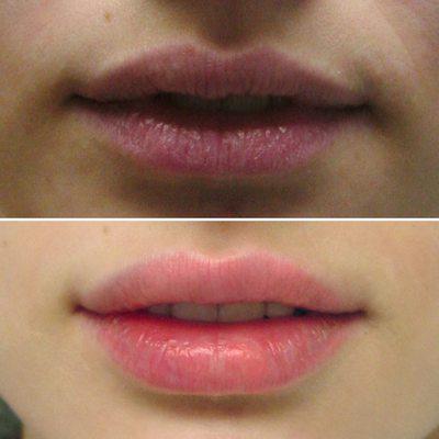 Before and After: Juvedurm Ultra Plus for naturally fuller lips.