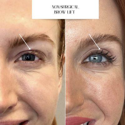 Non surgical brow lift performed with Microneedling + Radiofrequency