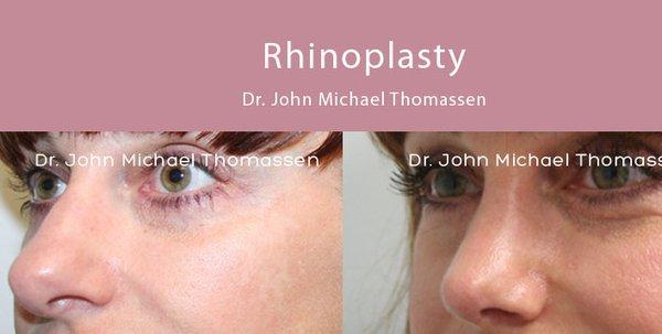 Fort Lauderdale Plastic Surgery by Dr. John Michael Thomassen - Board Certified Plastic Surgeon...