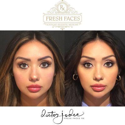 Fresh Faces Rx midface filler