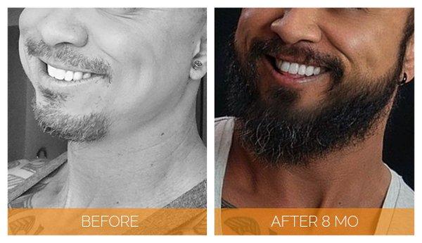 40-year old Nashville Hair Doctor beard transplant patient 8 months post-op.