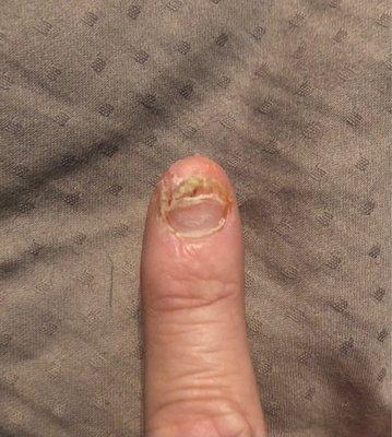 by Julie. Burned, itched. Acrylic overlapping on  my skin. Nails lifted & fell off leaving a disfigured nail