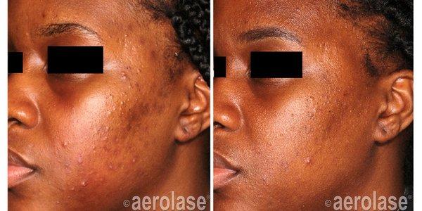 Acne laser treatment after 4 sessions - no loss of skin tone. Neo-Aerolase safe all skin types