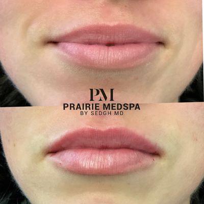 Lip enhancement at Prairie Medical Spa