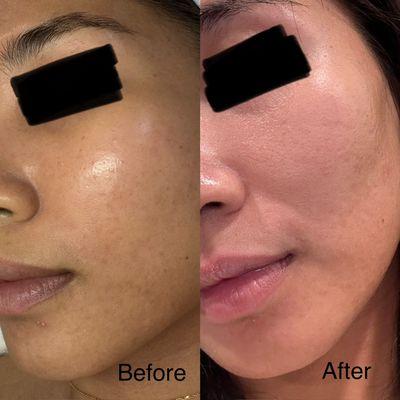 2 weeks after chemical peel level 1