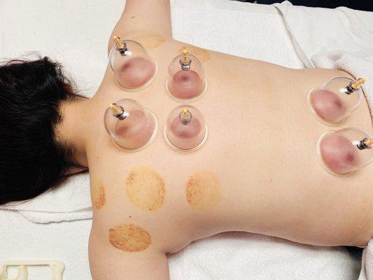 Cupping therapy  Relieve pain ,dredging tendons ,relaxing muscles and body detox