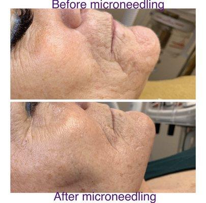 Microneedling before and after