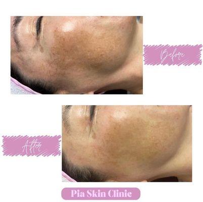 Hyperpigmentation Treatment