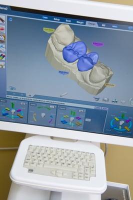 Technology: 3D Computer impressions. No gooey trays.