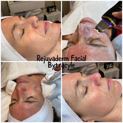 Rejuvaderm facial by Tracy Le