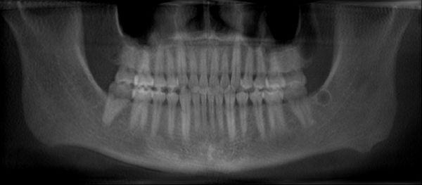 Honolulu tooth implant