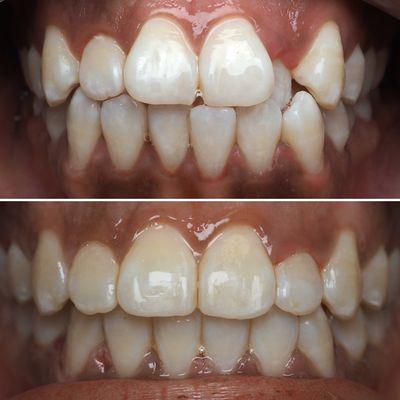 Orthodontic treatment completed using traditional braces.