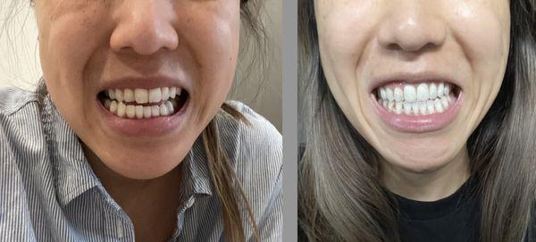 Left (Before) - Jaw dislocation. Right (After) - Teeth are almost back in place