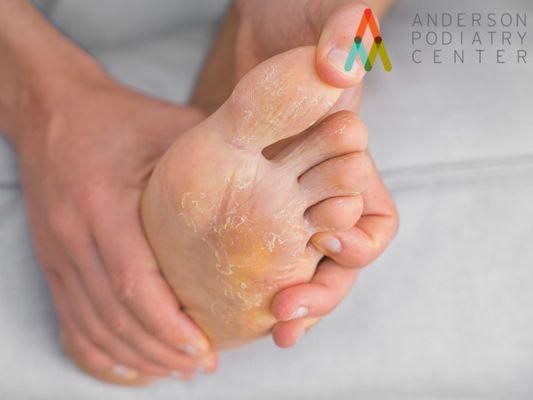 Foot Eczema Treatment