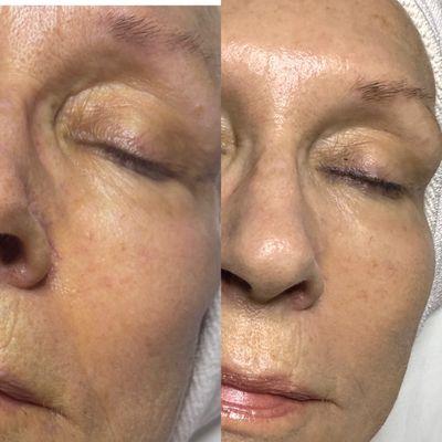 Microchanneling Collagen Induction therapy!