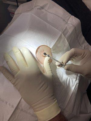 Dr. Sherman performing a BioTe hormone pellet procedure