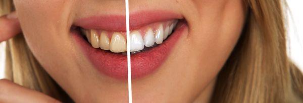 We offer ZOOM in-office whitening services. You will walk out of the clinic with a brand new white smile that lasts!