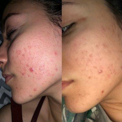 Before and after Oxygen Rx treatment. Great for acne, redness, and rosacea. You can have the skin you want!