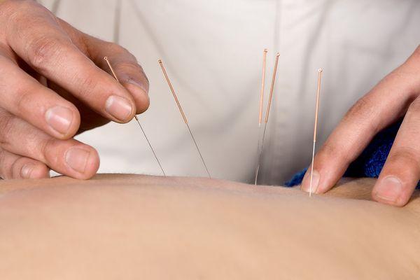 acupuncture treatment