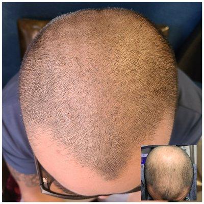 Scalp Micropigmentation by Julie.  Call for your free consultation.