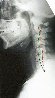 My x-ray side view.