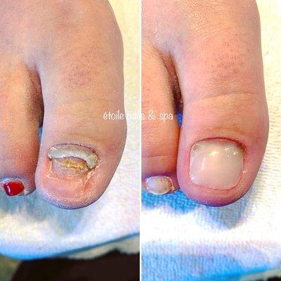 LCN Barefoot - toenail reconstruction, available only at Étoile!