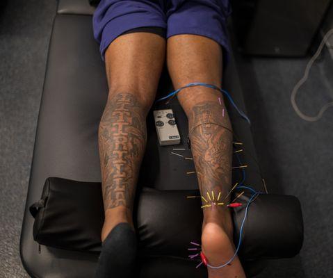 Dry Needling with electric stim