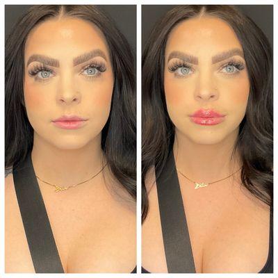 Lip filler before and after