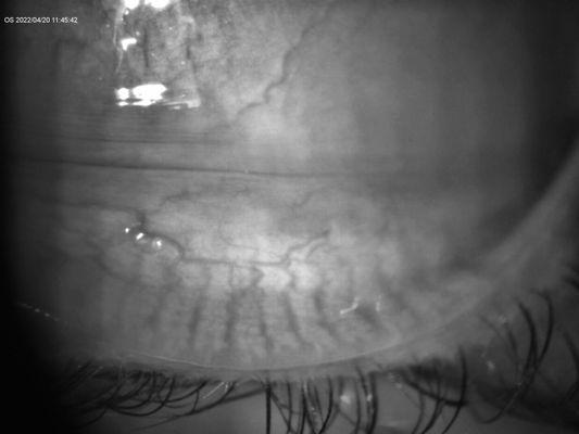 Imaging of meibomian glands to evaluate dry eye