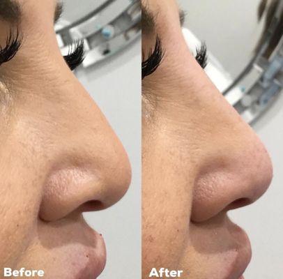 Love this transformation! Non-Surgical rhinoplasty achieved with dermal filler.