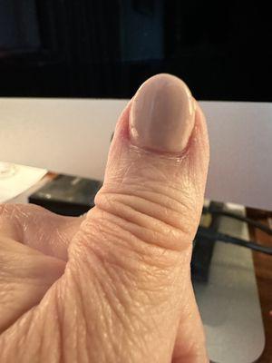 left thumb with all the red and flaking skin