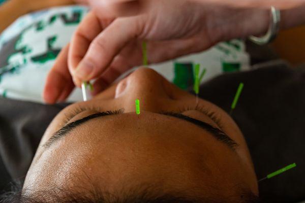 Facial Rejuvenation Acupuncture/Cosmetic Acupuncture Treatments.