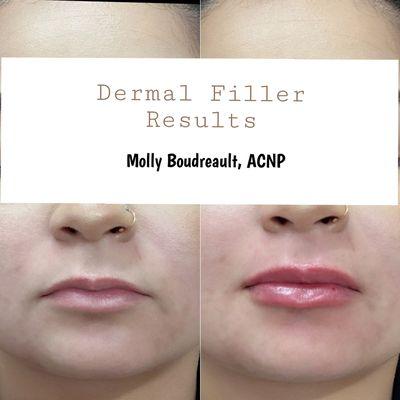 Lip filler results by our aesthetic nurse practitioner, Molly Boudreault