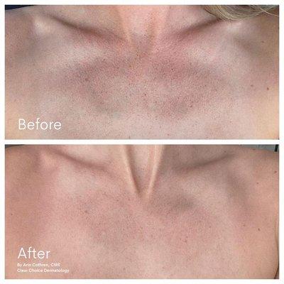 After 1 Vi Body Peel