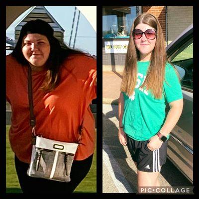 Hello Jessica, thank you for sharing your amazing results after gastric Sleeve surgery at Arch Bariatrics, St Louis.