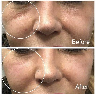 Are you loosing volume and getting hollows under your eyes, we do instant correction.