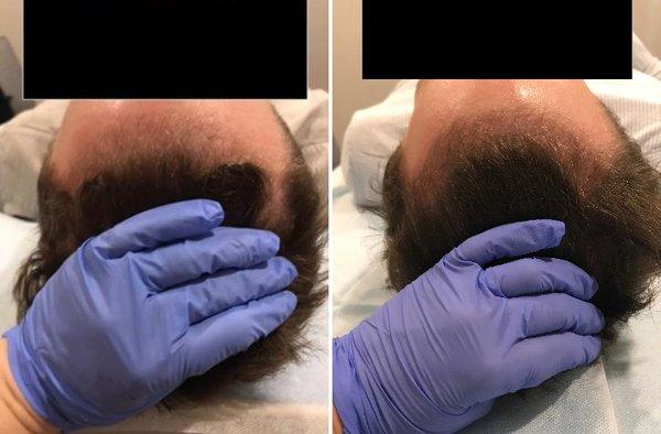 PRP Hair - Before and After