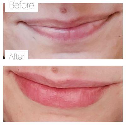 Lip fillers with RN Marina. (Before and immediately after)