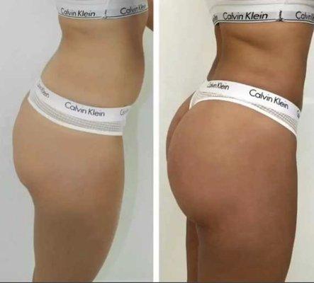 Cavitation and butt plump