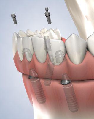 Huntsville Oral Surgery & Dental Implants