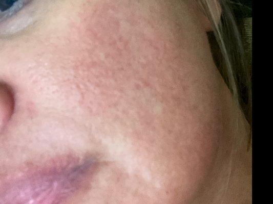 Skin catastrophe after one Laser Skin & Wellness Laser treatment