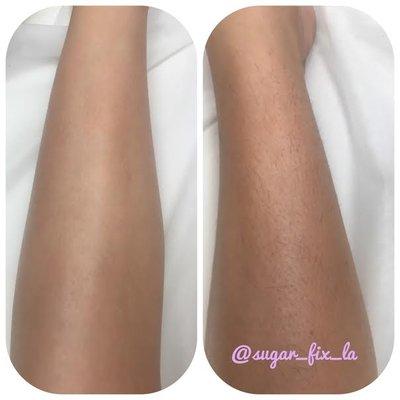 Before and After Half Leg