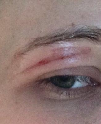 Two weeks ago today, I was burnt so severely getting my eyebrows waxed that I got 2nd degree burns.