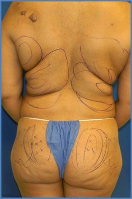 Laser Liposuction Before