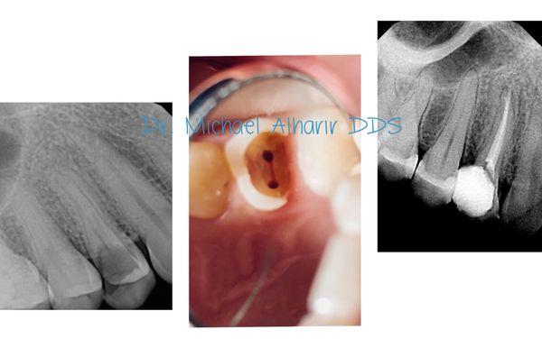 Root canal tooth# 5, two canals.