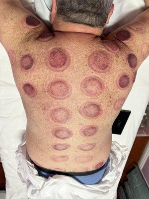 Cupping Therapy